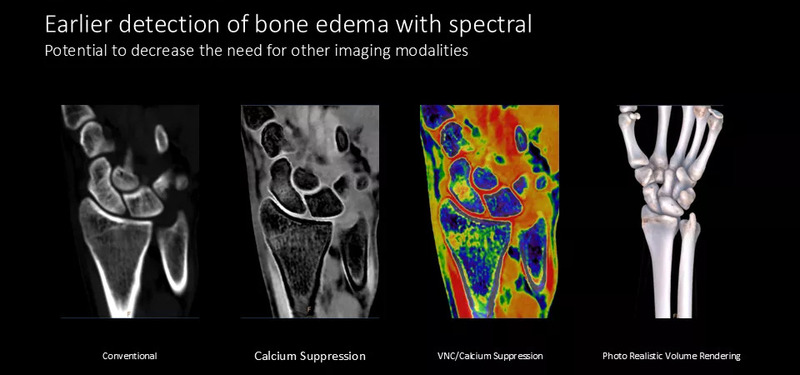 Система компьютерной томографии Philips Spectral CT 7500